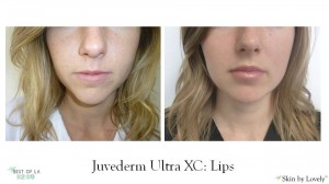 Juvederm Cost Lips