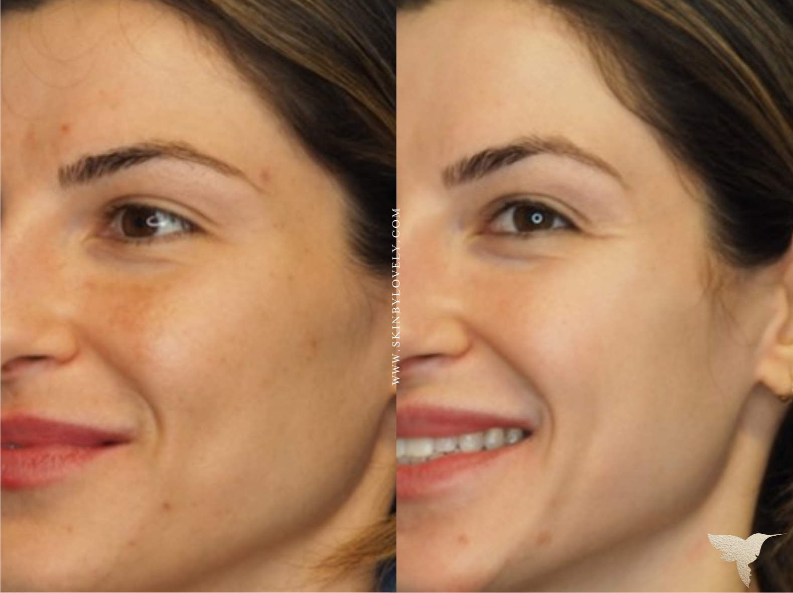 Cosmelan Depigmentation Peel | Chemical Peel | CA, OR & WA