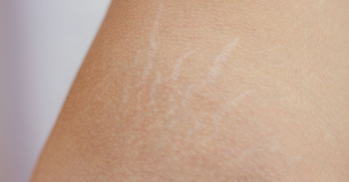 How Microneedling Can Help With Stubborn Stretch Marks